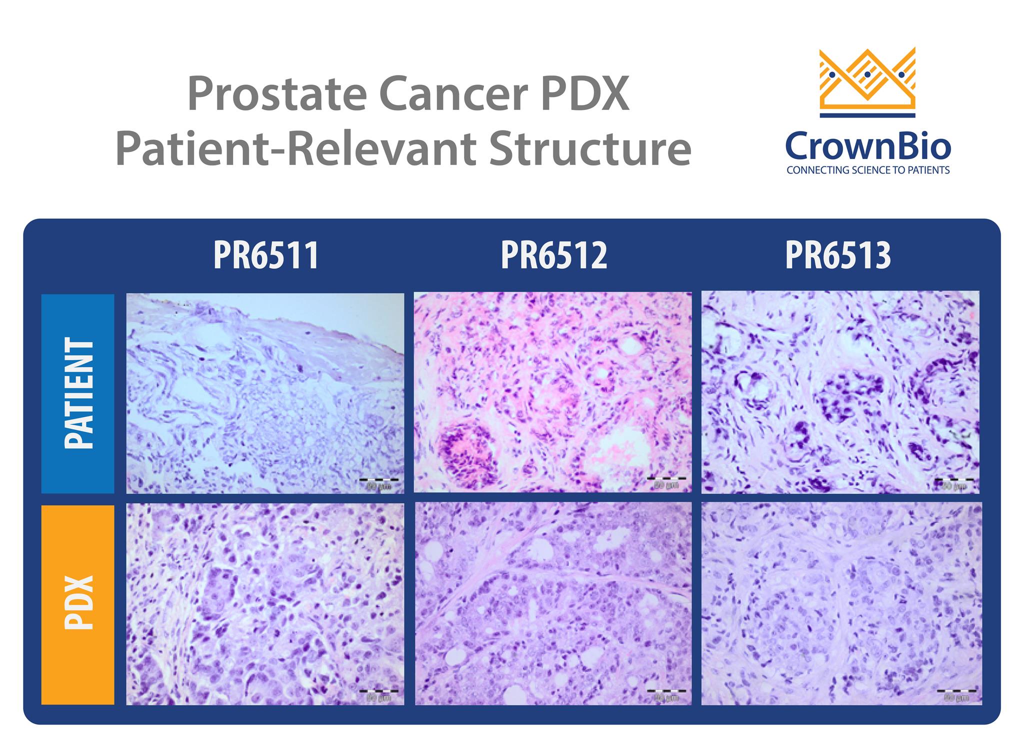 前列腺癌患者衍生异种移植（PDX）模型